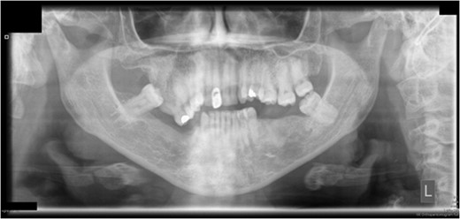 Preoperative orthopantomograph showing expansion of the right maxillary tuberosity.