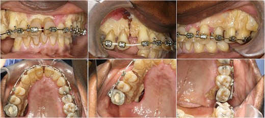 Photographs at 6 months post surgery.