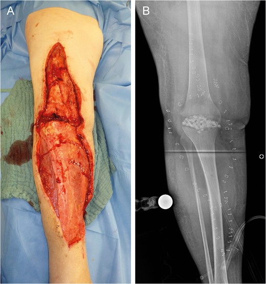 Left lower limb tissue defect on admission (A) and corresponding X-ray (B).