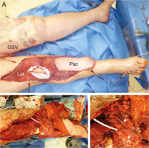 Reconstruction by combined Parascapular (Psc) and latissimus dorsi (Lat) flap with GSV donor site (A). Intraoperative images with pedicle anastomoses (arrows) (B and C).