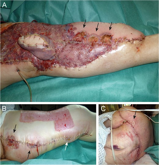 Eleven days after tissue coverage: suppurative, necrotic ulcers (arrows) on flap (A) and donor sites (B and C).