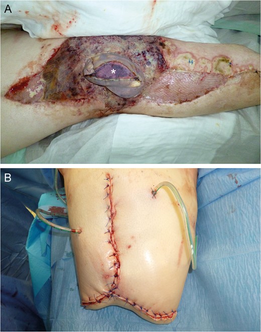 Near-total flap loss on Day 22. Note the livid discoloration of the monitor island (asterisk) indicating severe tissue hypoxemia (A). Above knee amputation site (B).