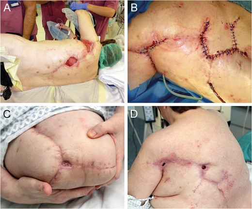 Flap donor site coverage by rhomboid transposition flap (A and B). State on demission (C and D).