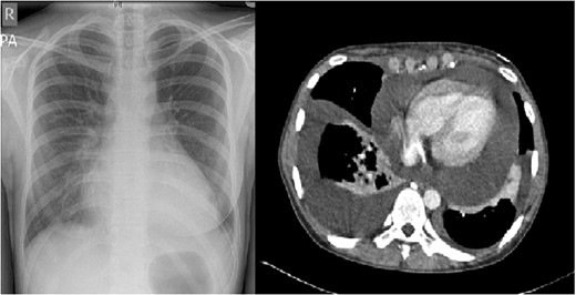 Pre-operative chest radiograph and axial view of a CT thorax, demonstrating a large pericardial collection.