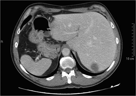 Preoperative CT scan.