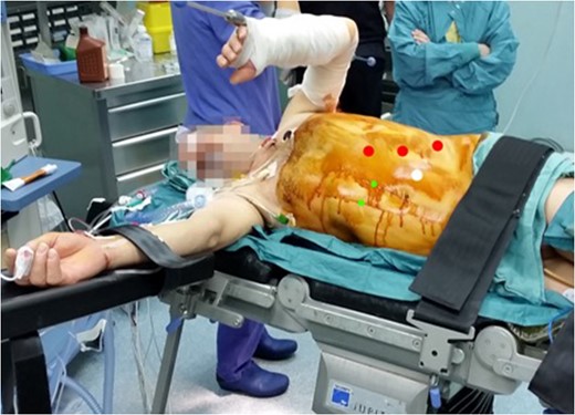 Position of the patient on the operating table and position of the trocars.