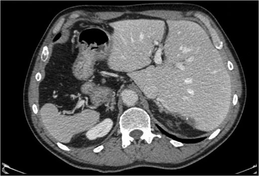 Postoperative CT scan 6 months after liver resection.