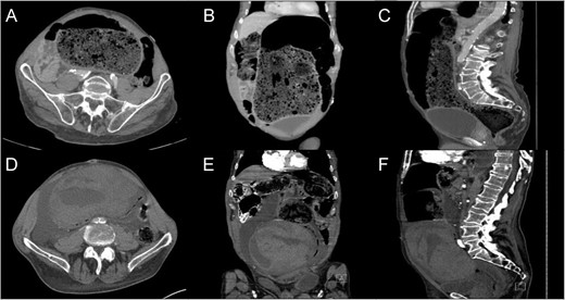 CT – Abdomen and Pelvis with intravenous contrast. Admission imaging demonstrating large colonic stool burden in the axial (A), coronal (B) and sagittal orientation (C). CT abdomen and pelvis following enema demonstrating large colonic wall hematoma axial (D), coronal (E) and sagittal orientation (F).