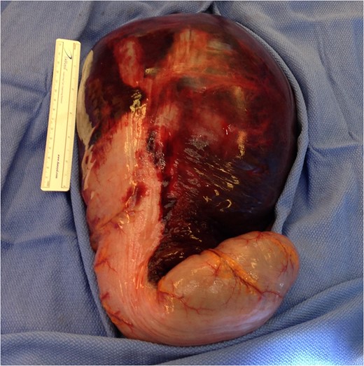 Intraoperative photograph of the large intramural hematoma of the sigmoid colon descending into the recto-sigmoid junction.