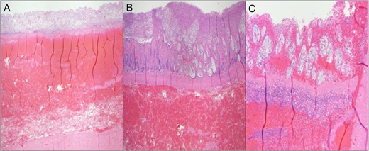 Pathologic colonic cross section. (A) Hemorrhagic infarction of the sigmoid colon. (B) Ischemic bowel with pseudomembrane formation. (C) Ischemic bowel with hemorrhage and pseudomembrane formation.