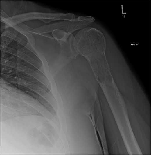 X-ray showed lytic lesion and pathological fracture of left proximal humerus. Plain radiographs of the left.