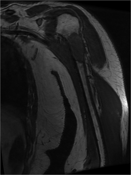MRI left humerus showed pathological fracture of the neck and proximal shaft humerus, measure 6 Ă— 2.5 Ă— 2.8 cm in maximal dimension. An urgent staging magnetic resonance.