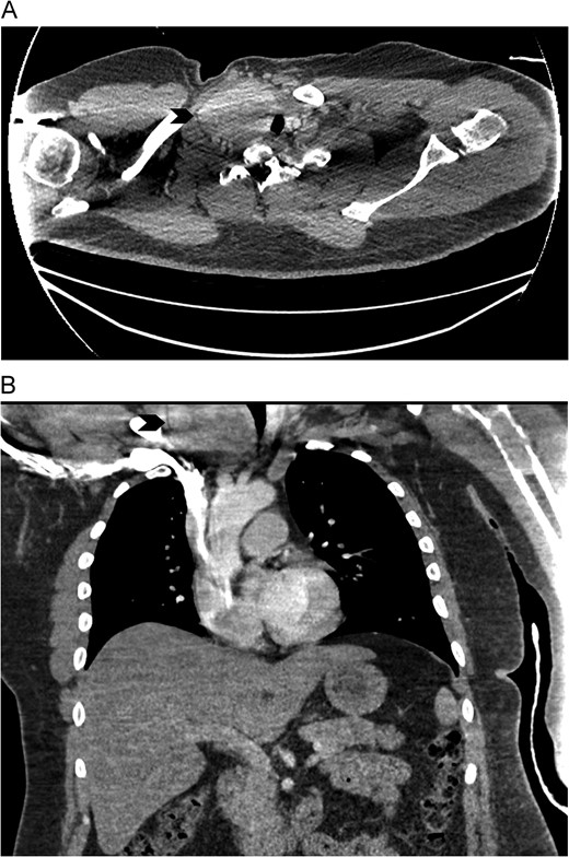 CT Chest with contrast showed an enlarged right lobe thyroid gland with retrosternal extension causing compression and deviation of trachea (arrow). (A) axial view. (B) coronal view. CT scan.