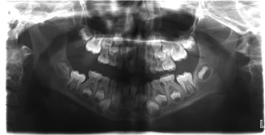 Orthopantomogram (OPG) of the patient with longstanding dislocation.