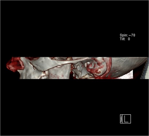 Computerized tomography (CT) scan of the dislocated left temporomandibular joint.