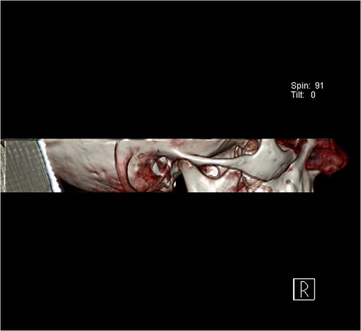 Computerized tomography (CT) image of the normal right temporomandibular joint.