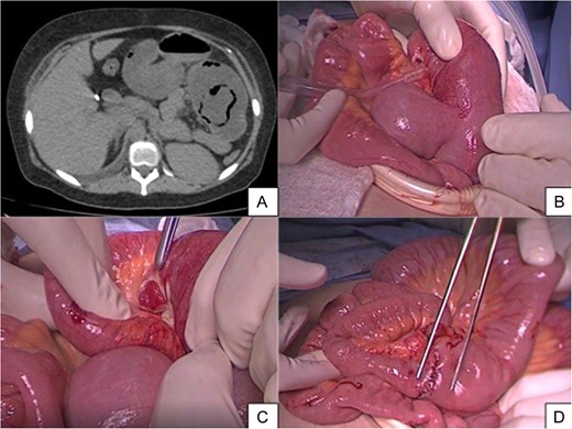 (A) Axial cross-section of MSCT without intravenous contrast where an aerial image is seen in halo which could correspond to pneumatosis and parietal swelling, image compatible with jejunojejunal invagination. (B) Intraoperative finding of intussusception. (C) The presence of necrosis in intussuscepted segment. (D) Jejunojejunal anastomosis is indicated with dissection tweezers.
