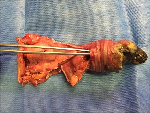 The dissection tweezers show the invaginated bowel segment. On the far right, an area of necrosis is seen with fibrine greenish streaks.