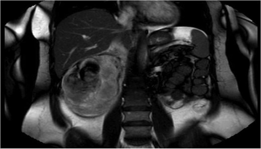 Magnetic resonance cholangiopancreatography (MRCP) on admission, showing an exophytic mass arising from posterior right kidney, with adjacent 8.3 × 10 cm2 retroperitoneal haematoma.