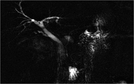 Admission imaging revealing dilatation of the common bile duct (8 mm), due to external compression.