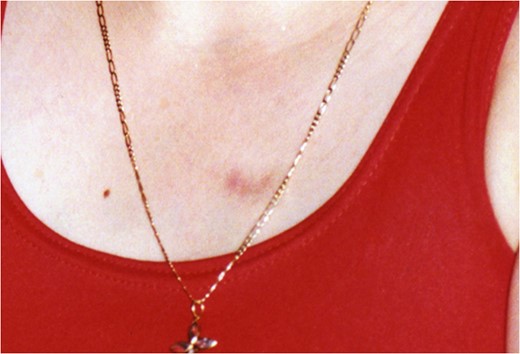 The vascular malformation of the patient 18 years ago.