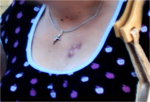 The vascular malformation of the patient 7 years ago.