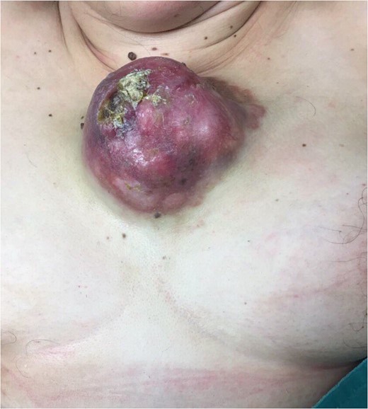 The tumor 6 months prior to presentation in our clinic after embolotherapy.