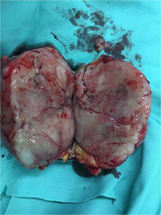The resected tumor.