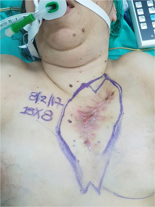 The wide excision of the tumor with a 3–4 cm margin.