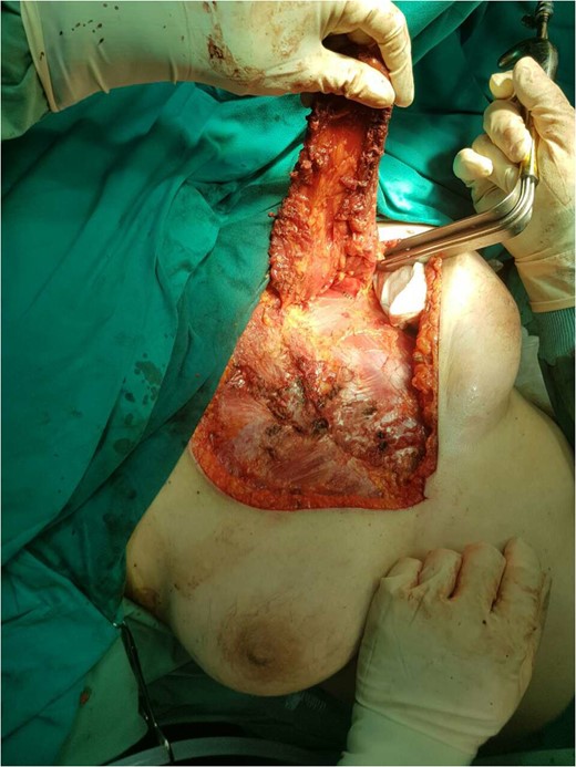 Reconstruction with bilateral pectoralis major muscle advancement flaps.