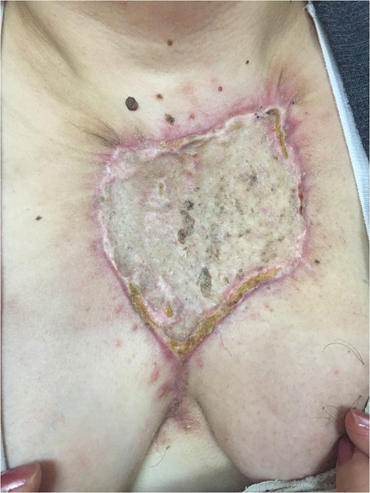 The full thickness skin graft from the abdominal wall to the sternal region 20 days after surgery.