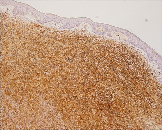 CD34 positive cells. Note the crenz zone between the tumor and epidermis.