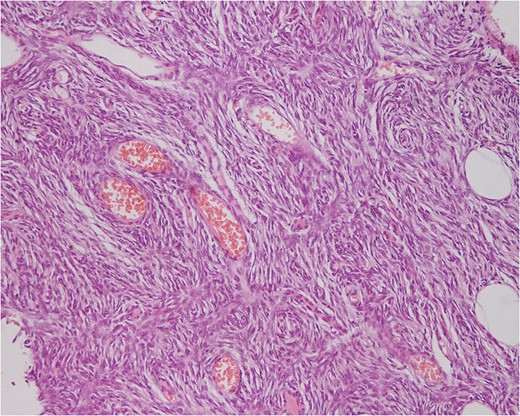 n the wide excision a coincidence of a vascular malformation/carvenous hemangioma in the upper dermal of the neoplasm (DFSP-FS).