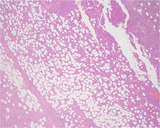 The DFSP-FS tumor.