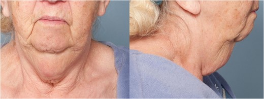 Elderly woman with a large ‘turkey gobbler’ skin tag of the neck.