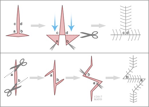Upper: Burow’s triangles advancement flap. Lower: The 45-degree Z-plasty.