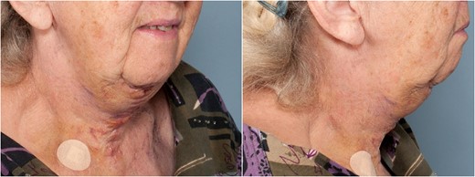 At 2 months’ follow-up.