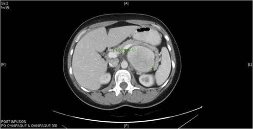 Computed tomography (CT) abdomen horizontal section of Castleman’s disease in accessory spleen.