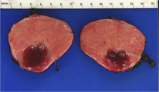 Gross pathology of Castleman’s disease arising from accessory spleen.