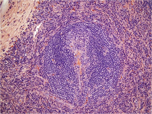 Histological pathology of Castleman’s disease, hyaline vascular variant. Involuted follicular germinal center penetrated by hyalinized small vessels and surrounded by concentric ‘onion rings’ of mantle zone lymphocytes.