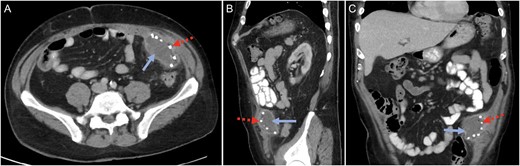 Computed tomography (CT) scan in the (A) cross-sectional, (B) sagittal and (C) coronal planes confirming a mesh-related abscess in the left iliac fossa. Solid blue arrow marks the abscess. Broken red arrow marks the metallic tack that was used to secure the intraperitoneal mesh.
