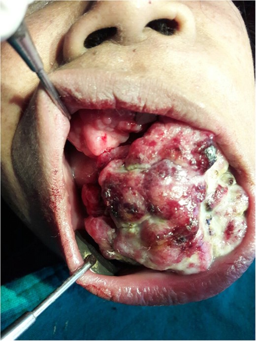 Patient presented with marked swelling of her gums with extensive areas of surface ulceration and pus collection.