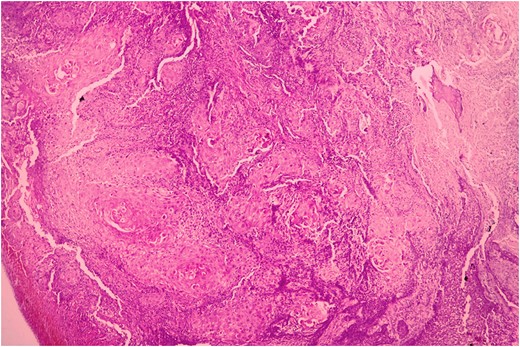 Histopathological picture showing islands of squamous cell carcinoma infiltrating into the stroma. (H&E, ×400).