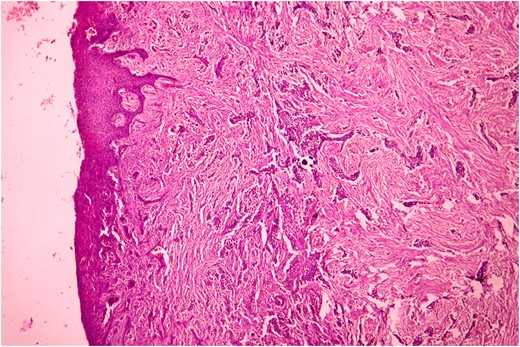 Histopathological picture showing infiltrating squamous cell carcinoma along with bundles of collagenous fibrous connective tissue. (H&E, ×400).