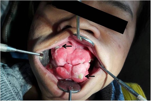 Younger sister of the patient presenting with swelling of her gums and impacted teeth (black arrow) in fibrous growth.