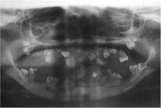 X-ray picture of younger sister showing impacted and malpositioned permanent teeth in upper and lower arch.