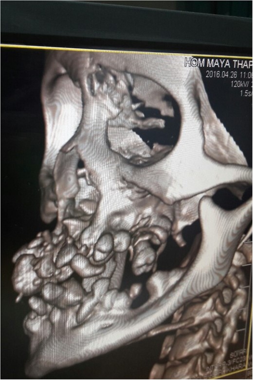 CT scan of younger sister showing permanent teeth in both upper and lower arch which are malpositioned and unerrupted and impacted.