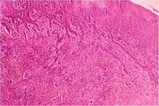 Histopathological picture of younger sister showing stratified squamous lining and subepithelium shows rich collagenous fibrous connective tissue with mild inflammatory cells. (H&E, ×400).