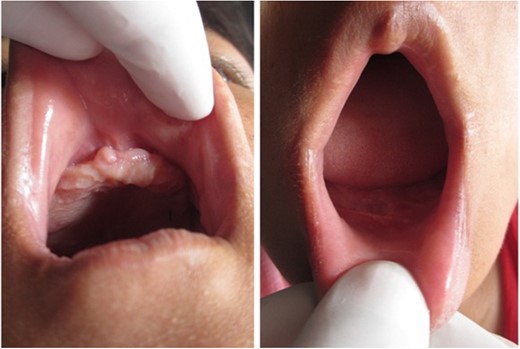 Younger sister’s oral cavity after two stage gingivectomy.