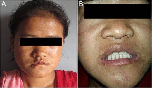 Post-operative picture after 3 months (A) and prosthetic rehabilitation with upper and lower complete removable denture of younger sister on follow-up after 6 months (B).